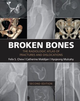 Broken Bones The Radiologic Atlas of Fractures and Dislocations 2nd 2E